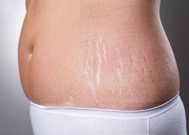 कुछ घरेलू चीजों की मदद से स्ट्रेच मार्क्स होंगे दूर