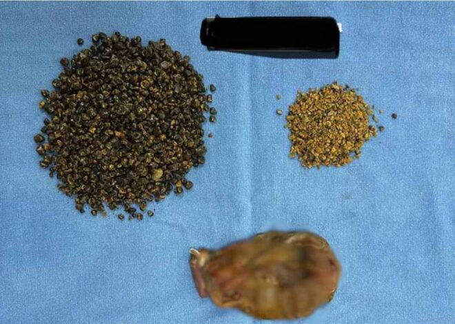 गुरुग्राम: एक दुर्लभ सर्जरी 60 मिनट तक चली, पेट से निकले 8125 स्टोन्स, डॉक्टर भी रह गए दंग, गिनने में लग गए 6 घंटे