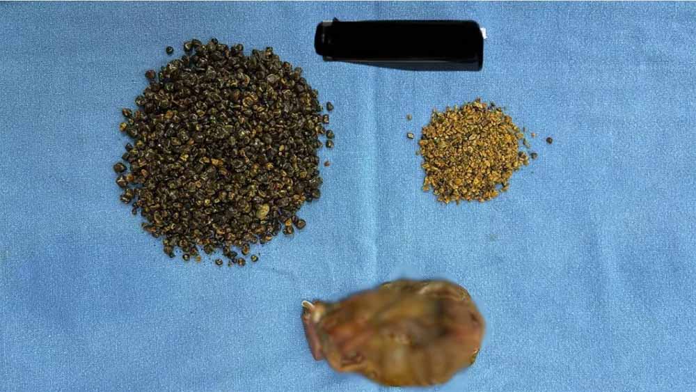 गुरुग्राम: एक दुर्लभ सर्जरी 60 मिनट तक चली, पेट से निकले 8125 स्टोन्स, डॉक्टर भी रह गए दंग, गिनने में लग गए 6 घंटे